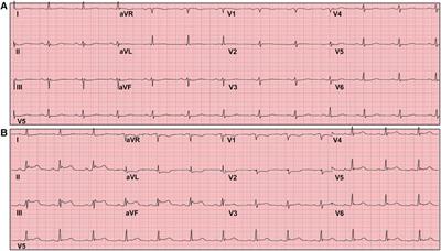 Case Report: Vasospastic angina presenting as phantom odor perception
